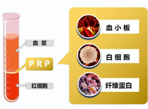 抽自己的血，治自己的病——PRP到底是什么？