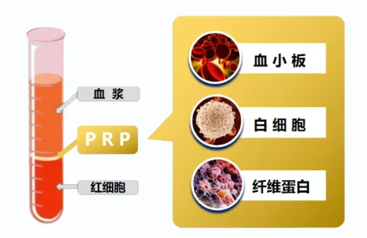 抽自己的血，治自己的病——PRP到底是什么？