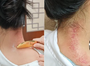 肩硬、腰酸、失眠、湿气重，试试中医“虎符铜砭刮痧”，刮透瘀堵一身轻