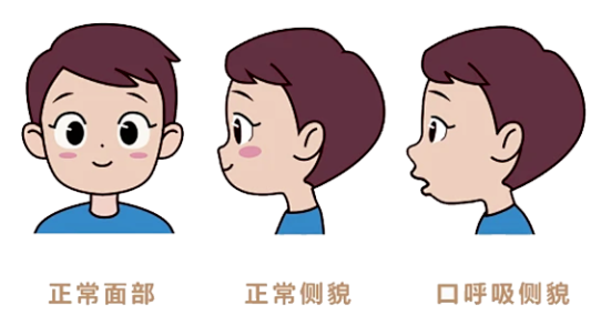 孩子睡觉张嘴、打呼噜？家长当心！别让“口呼吸”偷走孩子的颜值和健康